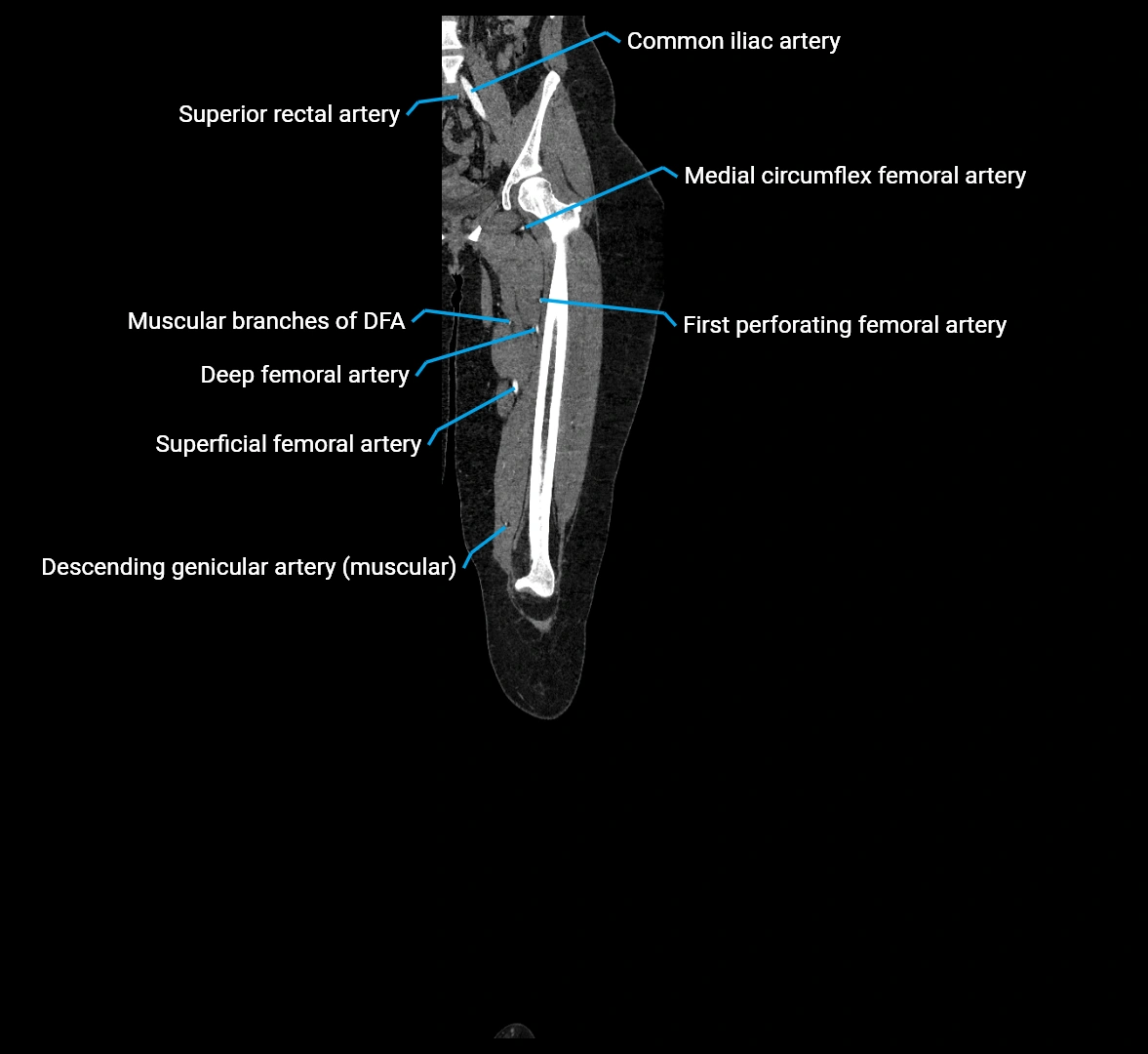 CTA lower limb coronal cross sectional anatomy labelled image _32 (2).webp